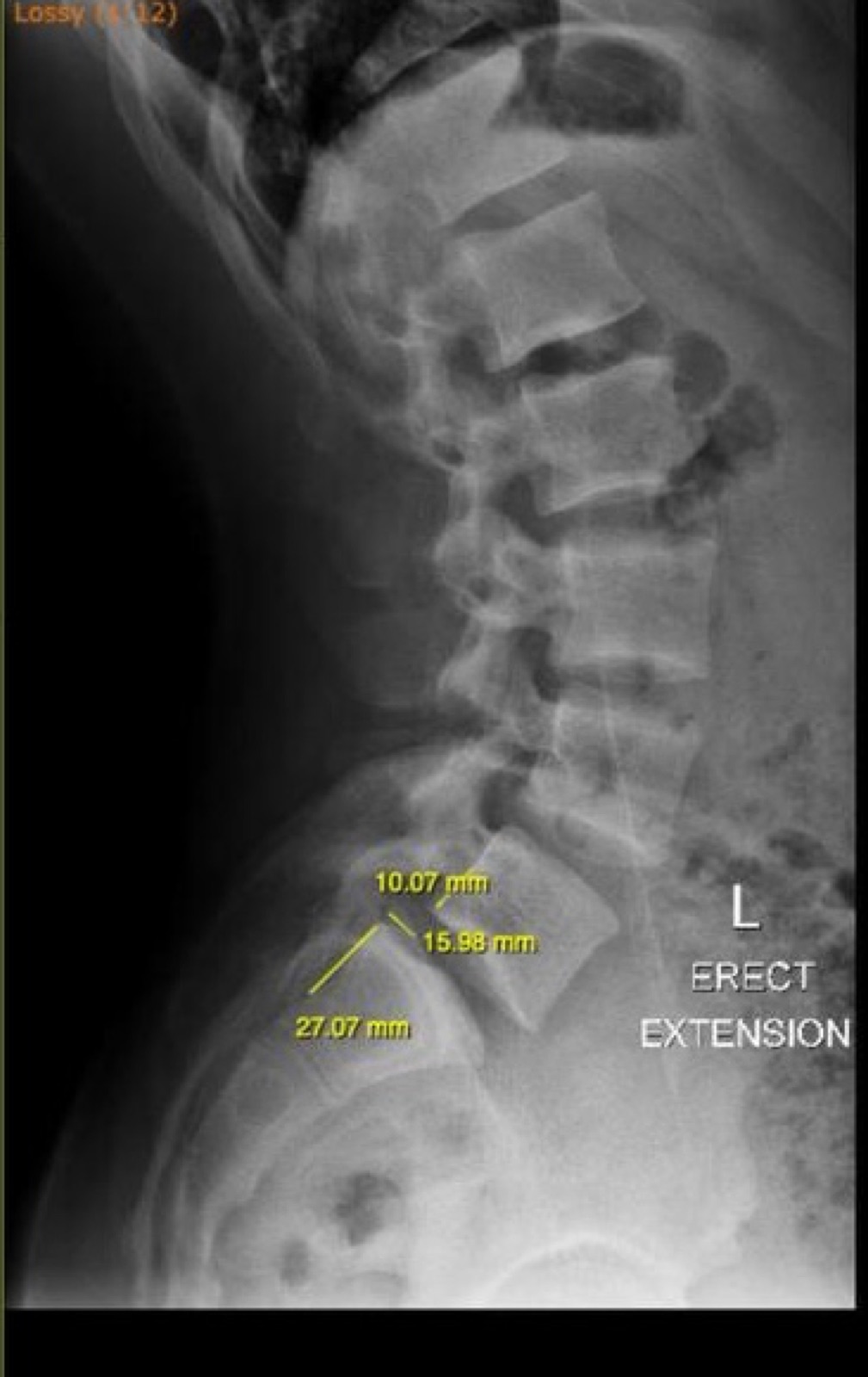Lumbar spine X-ray showing a slipped disc